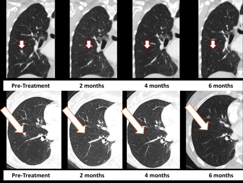 Treatment with Bria-OTS monotherapy resulted in 100% resolution of tumor in the right lung of the metastatic breast cancer (MBC) patient following 2 months of therapy and confirmed at 4, and 6 months of therapy  (axial and coronal views)